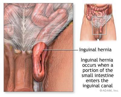 The New York Times Health Image Inguinal Hernia