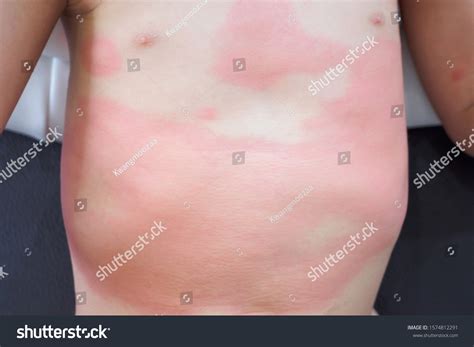 Severe Eczema Skin Rash Allergic Reaction Stock Photo 1574812291