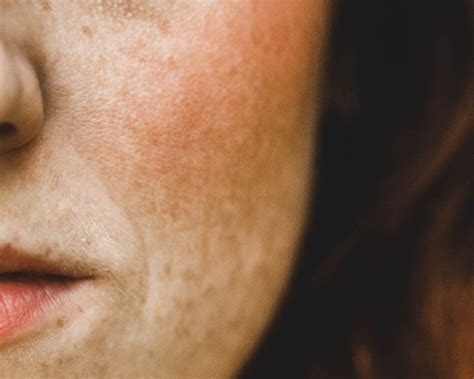 Understanding Melasma Vs Hyperpigmentation What You Need To Know