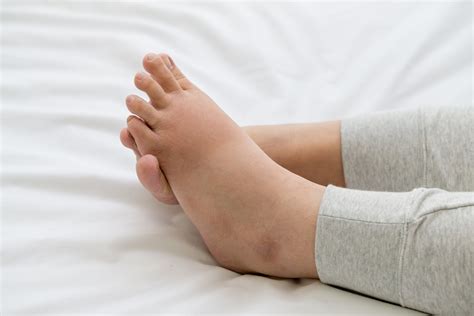 Edema Swelling During Pregnancy How Is It Managed The Pulse