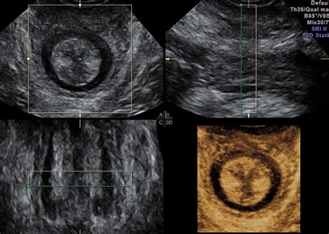 Three‐dimensional Transperineal Ultrasound Findings Associated With