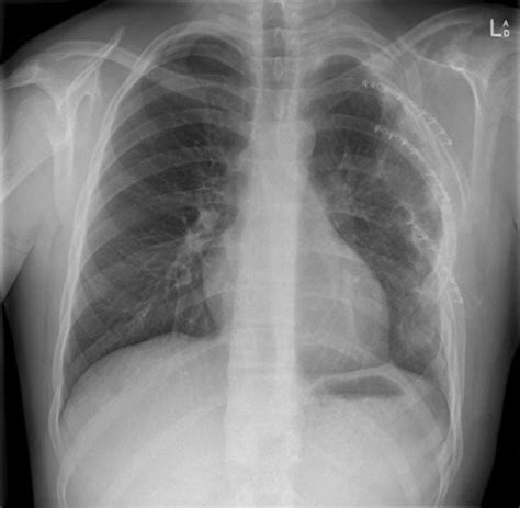 Possible more serious injuries with violation of the integrity of the bone and damage internal organs. Erect chest X-ray 3 months post injury showing complete ...