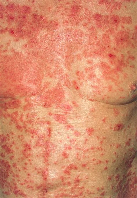 Acute Eczema On The Torso Of Alzheimers Patient Photograph By Dr P