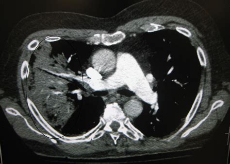 Filect Scan Of The Chest Demonstrating Right Sided Pneumonia