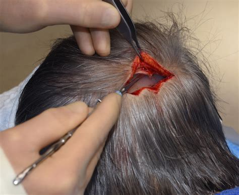 Plastic Surgery Case Study Custom Occipital Skull Implant Replacement