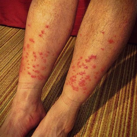 How To Avoid Chiggers And Ticks While Hiking
