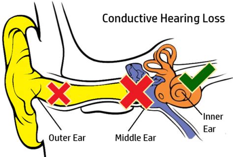 Why Cant I Hear Types And Causes Of Hearing Loss You Need To Know