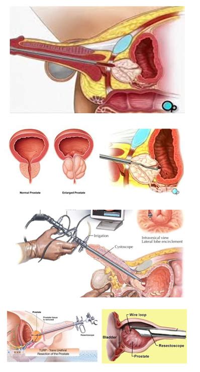 Detailliert Chinakohl Laser Turp Operation Prallen Wange Stra Ensperre