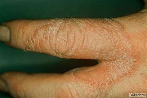 8 110 1 Tinea Of The Hand Caused By Trichophyton Rubrum