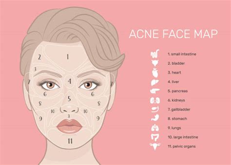 11700 Acne Stock Illustrations Royalty Free Vector Graphics And Clip