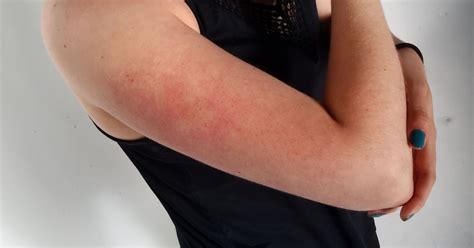 What Are Those Red Bumps At The Tops Of Your Arms And How Do You Get