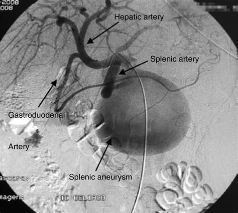 Spontaneous Rupture Of A Splenic Aneurysm In Classic Ehlersdanlos