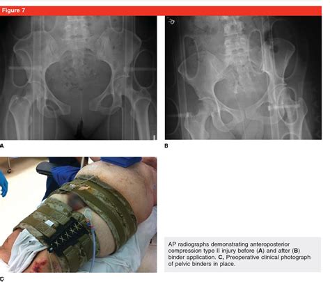 Pdf Pelvic Fractures Part 1 Evaluation Classification And