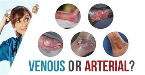 Venous Vs Arterial Whats The Difference Ulcers Wounds Nursing