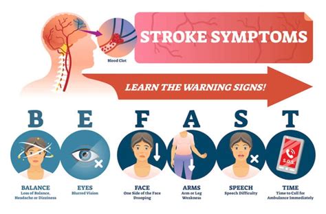Examining The 2021 Guidelines For Stroke Prevention