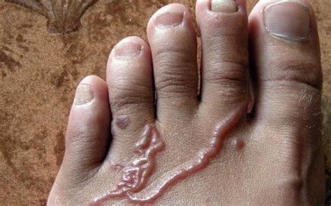 Hookworm Disease Causes Symptoms Diagnosis And Treatment Medical