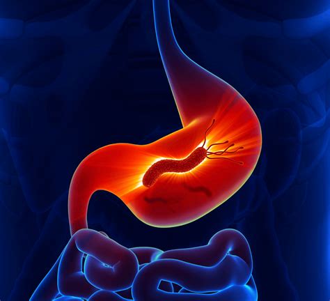 Peptic Ulcer Disease Causes Diagnosis And Treatment Pgl