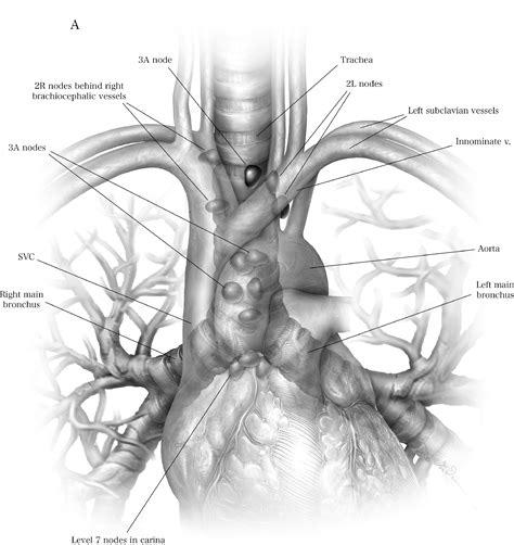 Endosonographic Lymph Node Staging By Combined Endobronchial Ultrasound