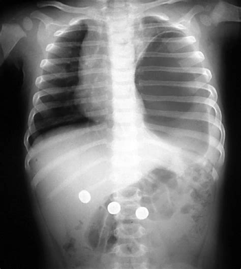 Late Presenting Congenital Diaphragmatic Hernia Emergency Medicine