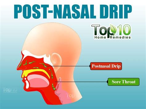 Illustration Showing Post Nasal Drip Stuffy Nose Remedy Post Nasal Drip Remedy Sinus Remedies