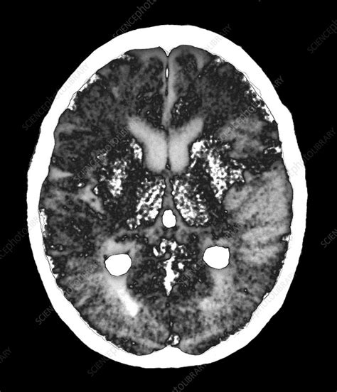 Does Brain Damage Show On Ct Scan Brainly Hje