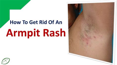 How To Get Rid Of An Armpit Rash Stop Rashes With Cold Compresses