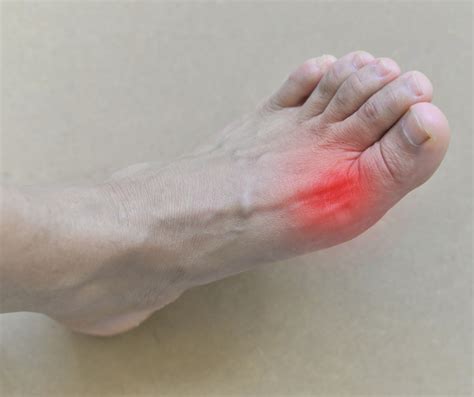 What Is The Cause Of Gout In The Ankle Goutinfoclub Com