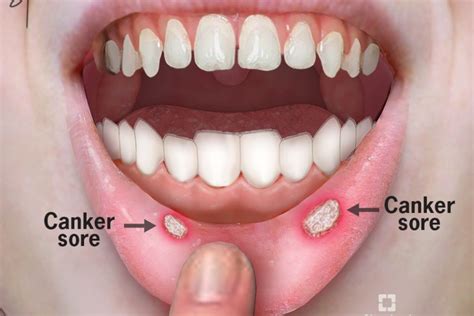 Mouth Ulcers Canker Sores Healthgistnet