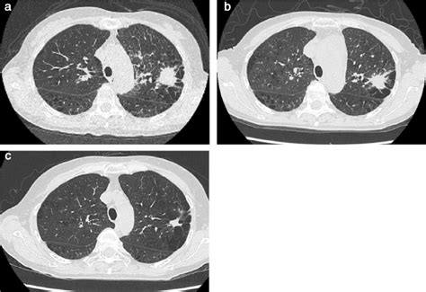 Serial Chest Computed Tomography Ct Findings Before And After