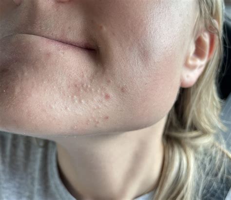 Acne Chin Has Been Like This For Years They Can Be Squeezed Out But Come Back Within 2 Weeks