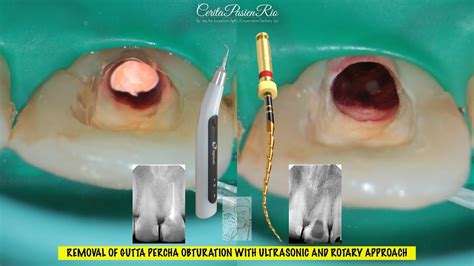 Removal Of Gutta Percha Ultrasonic Ultrax Eighteeth One Curve Micro