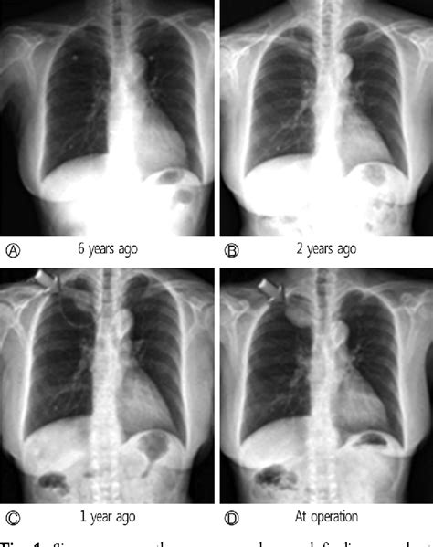 Figure 1 From A Late Onset Solitary Mediastinal Cystic Lymphangioma In