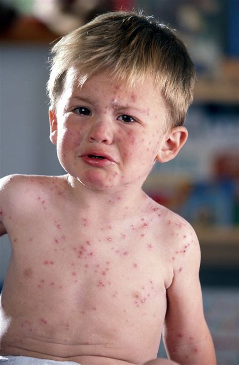 Coughing With A Rash In Children
