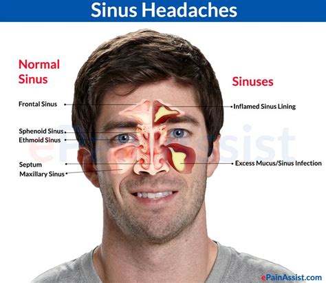 Pin On Sinus Relief