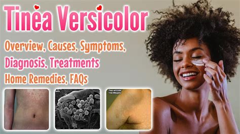 Tinea Versicolor Overview Causes Sign And Symptoms Diagnosis