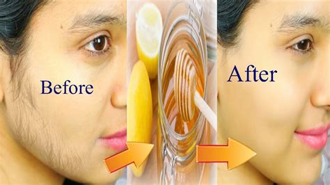 How To Remove Unwanted Hair Permanently At Home Naturally Health And