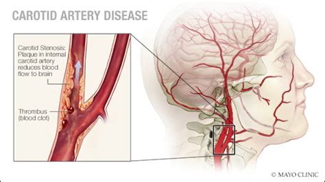In the neck, each of them branches off into an internal carotid artery. carotid - Liberal Dictionary