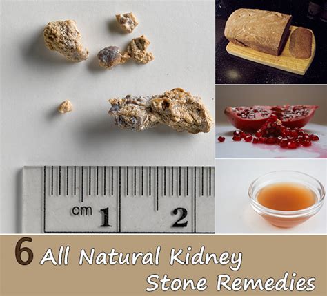 6 All Natural Kidney Stone Remedies Home And Gardening Ideas