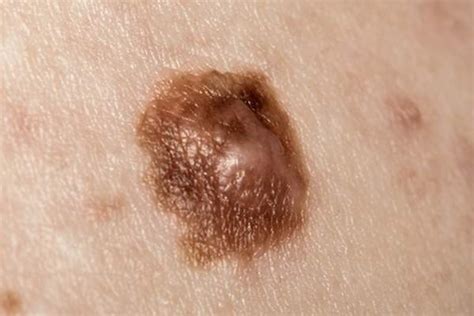 How Melanoma Develops From A Mole
