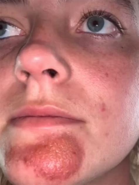 Woman Develops Staph Infection After Kissing Man With Stubble News