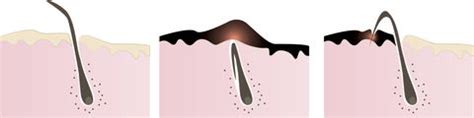 What's more, the pustules can go away fairly quickly, but the inflammation at the level of the hair follicle underneath the skin can feel like a hard knot for some time after, she says. How to Get Rid of an Ingrown Pubic Hair on Your Vagina