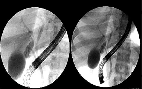 Endoscopic Retrograde Cholangiopancreatography Showing Normal Appearing