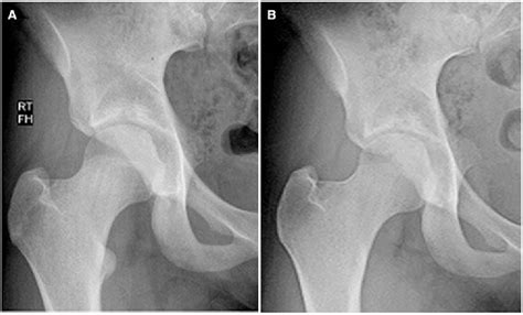 Pdf Treatment Of Ischiofemoral Impingement Results Of Diagnostic