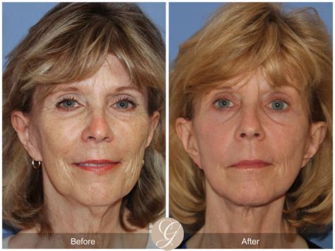 Facelift 413 Before After Photos Orange County