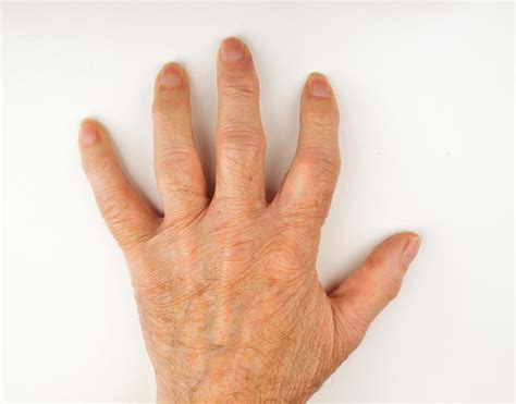 Wie Behandeln Sie Arthritis In Den H Nden Demedbook