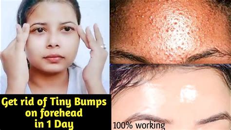 How To Get Rid Of Small Bumps On Forehead And Bumpy Skin Quicklyhindisk