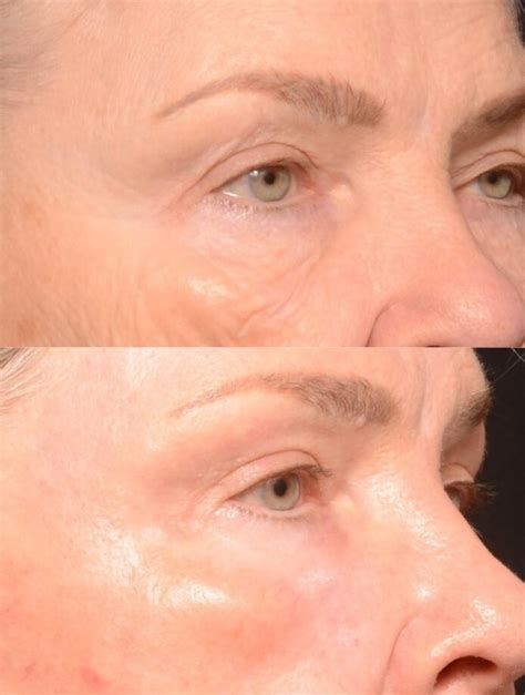 Laser Skin Resurfacing Before And After Brian S Biesman Md