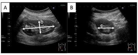 Normal Kidney Size Ultrasound