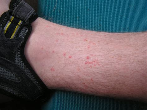 Help Im Getting Bit A Guide To Identifying Bug Bites — Expert Pest