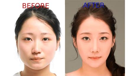 Korean Plastic Surgery Tour Package Combining Beauty And Exploration